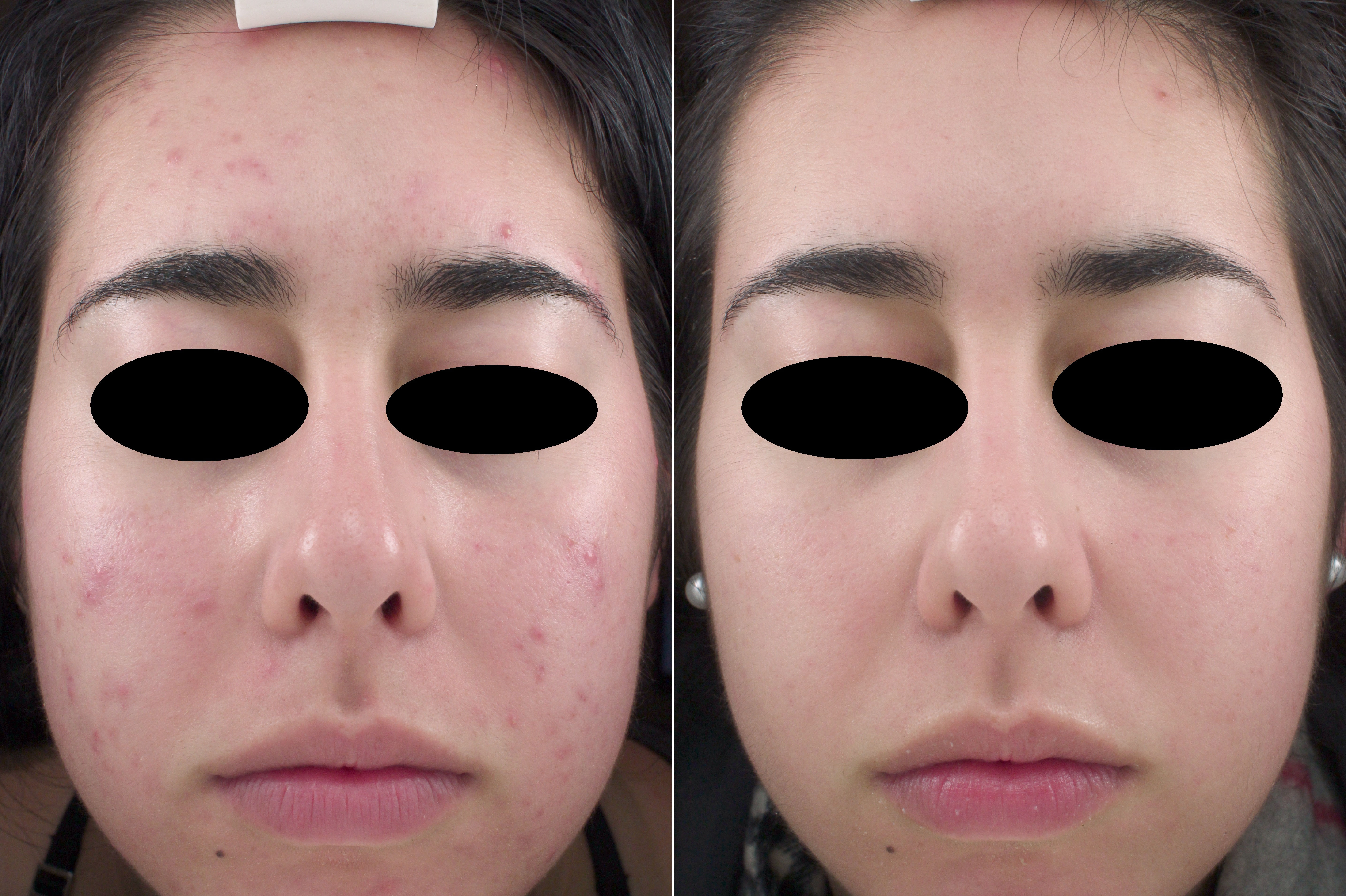 Acne Clinic Pickering - Before and After Picture